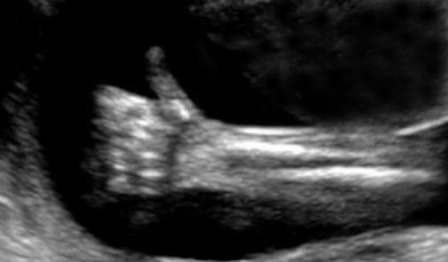 Hand in the Womb